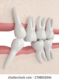 3d Render Of Teeth Sliding Towards The Area Of Missing Tooth In Order To Fill The Gap. Consequences Of Lower Tooth Loss.