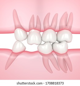 3d Render Of Teeth Sliding Towards The Area Of Missing Tooth In Order To Fill The Gap. Consequences Of Lower Tooth Loss.