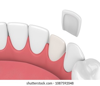 3d Render Of Teeth With Veneer Over White