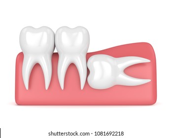 3d render of teeth with wisdom horizontal impaction over white background. Concept of different types of wisdom teeth impactions.