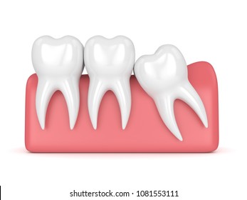 3d render of teeth with wisdom mesial impaction over white background. Concept of different types of wisdom teeth impactions.
