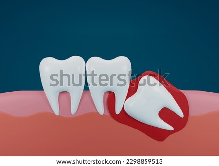 3d render of teeth with wisdom mesial impaction