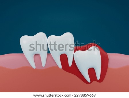 3d render of teeth with wisdom mesial impaction