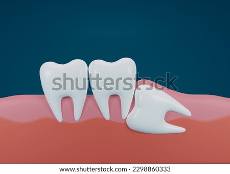 3d render of teeth with wisdom mesial impaction