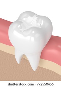 3d Render Of Tooth With Dental Composite Filling In Gums