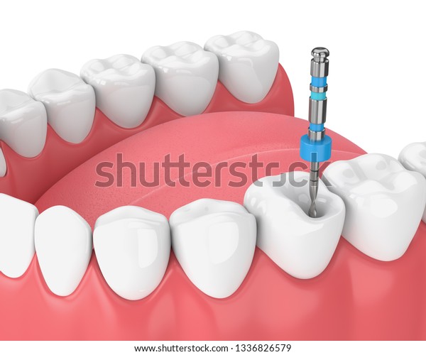 3d Render Tooth Endodontic File Gums Stock Illustration 1336826579