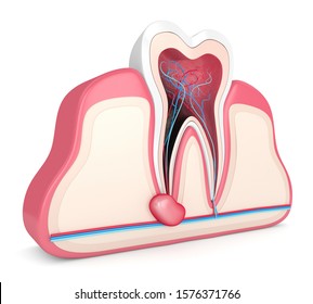 3d Render Of Tooth In Gums With Cyst. Dental Problem Concept.