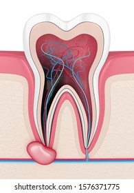 3d Render Of Tooth In Gums With Cyst. Dental Problem Concept.