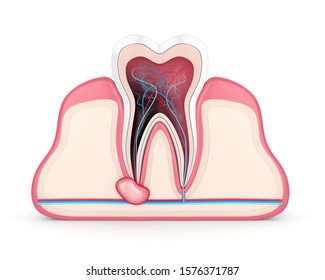 3d Render Of Tooth In Gums With Cyst. Dental Problem Concept.