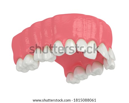 3d render of upper  jaw with abnormal teeth position. Orthodontic treatment concept. 