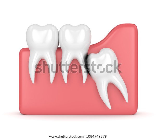 侵食空洞を持つ知恵の3dレンダリング 異なる種類の親知らずの歯の問題のコンセプト のイラスト素材
