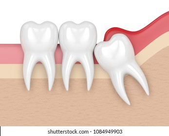 3d render of  wisdom mesial impaction with pericoronitis. Concept of different types of wisdom teeth problems.