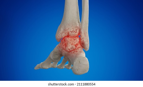 3d Rendered Illustration Of An Arthritic Ankle