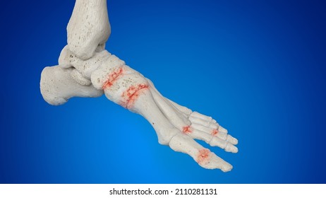 3d Rendered Illustration Of An Arthritic Foot