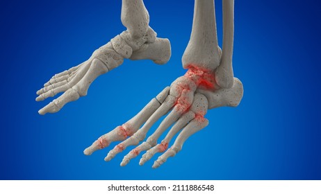 3d Rendered Illustration Of An Arthritic Foot