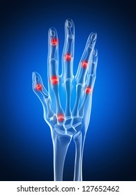 3d Rendered Illustration Of An Arthritic Hand