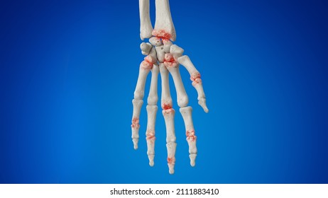 3d Rendered Illustration Of An Arthritic Hand