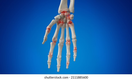 3d Rendered Illustration Of An Arthritic Hand