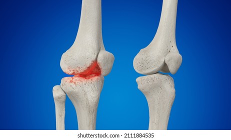 3d Rendered Illustration Of An Arthritic Knee Joint