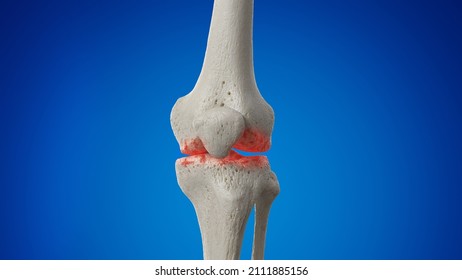 3d Rendered Illustration Of An Arthritic  Knee Joint