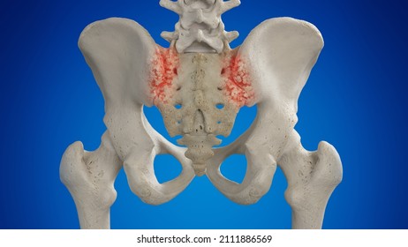 3d rendered illustration of an arthritic sacroiliac joint