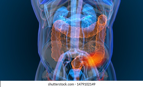 3d Rendered Illustration Of  Bowel Cancer 3D Illustration