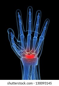 3d rendered illustration of the carpal tunnel syndrome
