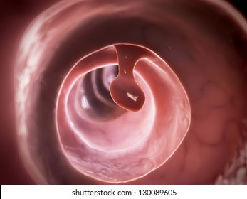 3d Rendered Illustration Of A Colon Polyp