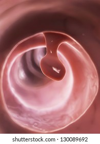 3d Rendered Illustration Of A Colon Polyp