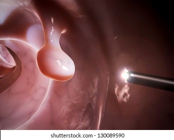 3d rendered illustration of a colonoscopy