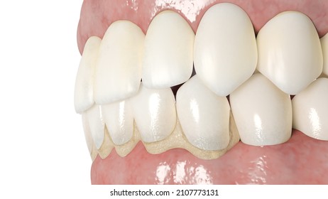 3d rendered illustration of a dental calculus