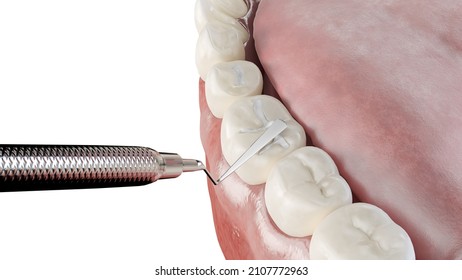 3d Rendered Illustration Of A Dental Fissure Filling