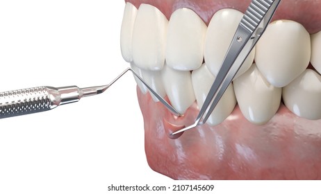 3d Rendered Illustration Of A Gum Graft Surgery