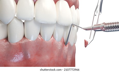 3d Rendered Illustration Of A Gum Graft Surgery