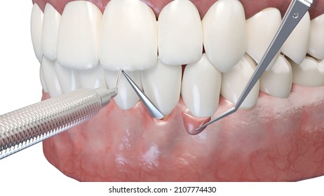 3d Rendered Illustration Of A Gum Graft Surgery