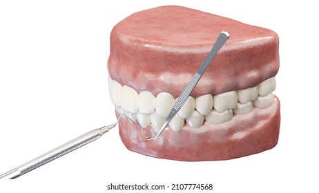 3d Rendered Illustration Of A Gum Graft Surgery