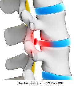 3d Rendered Illustration - Herniated Disk