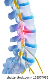 3d Rendered Illustration - Herniated Disk