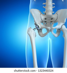 3d Rendered Illustration Of A Hip Implant