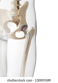 3d Rendered Illustration Of A Hip Replacement