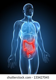 3d Rendered Illustration Of An Inflamed Colon