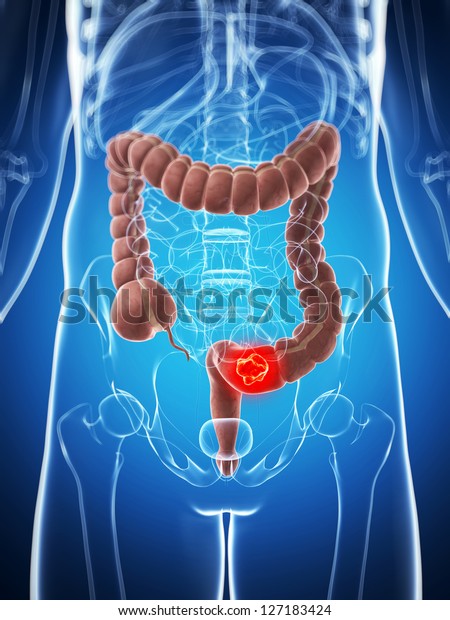 3d Rendered Illustration Male Colon Cancer Stock Illustration 127183424