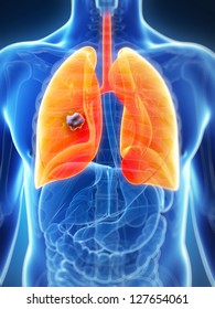 3d Rendered Illustration Of The Male Lung - Cancer