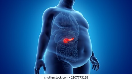 3d Rendered Illustration Of An Obese Mans Pancreas