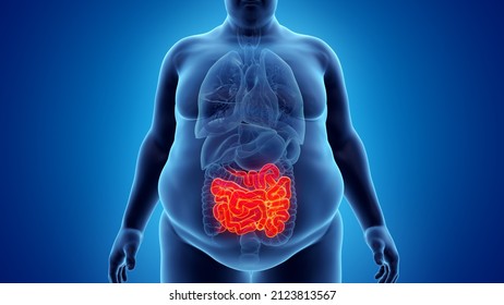 3d rendered illustration of an obese mans small intestine