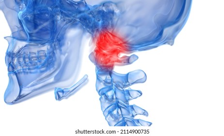3d Rendered Illustration Of A Painful Atlas Bone