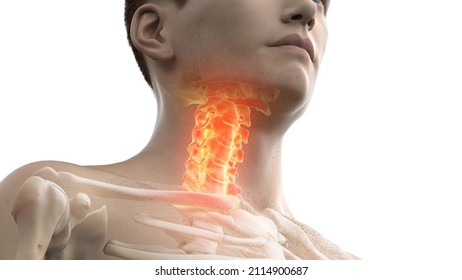 3d rendered illustration of a painful cervical spine - Shutterstock ID 2114900687