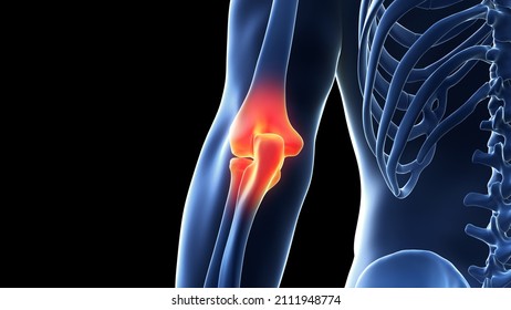 3d Rendered Illustration Painful Elbow Joint Stock Illustration ...