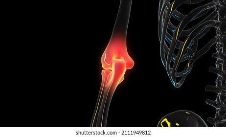 3d rendered illustration of a painful elbow joint
