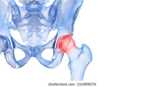 3d Rendered Illustration Of A Painful Hip Joint